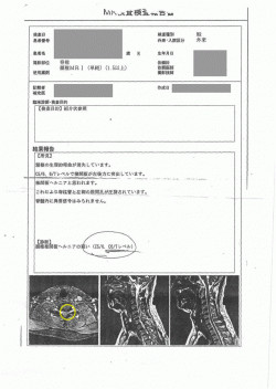 手術対象となる頚椎椎間板ヘルニア