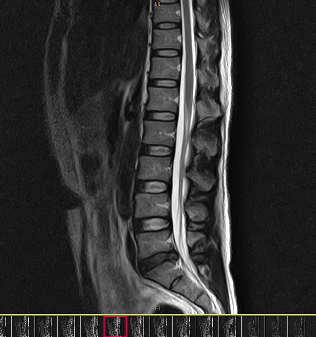 腰椎L5/S椎間板ヘルニアMRI画像（交通事故）