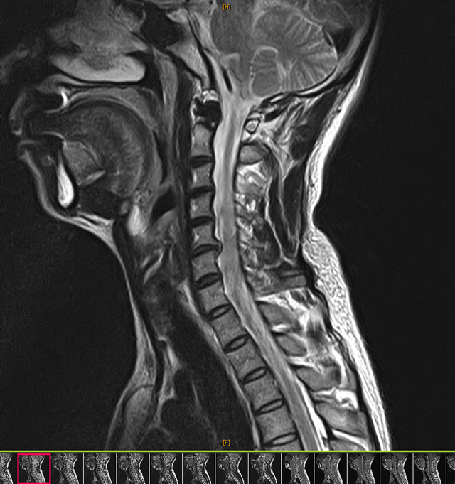 頚椎5/6椎間板ヘルニアMRI画像（交通事故）