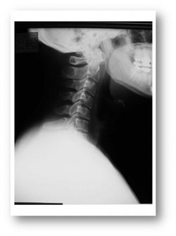 頚椎捻挫とストレートネック(交通事故)