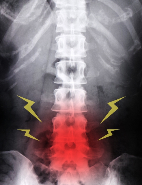 背骨の骨折・圧迫骨折での後遺障害（交通事故）