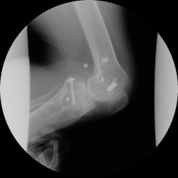 膝関節　半月板損傷（交通事故）
