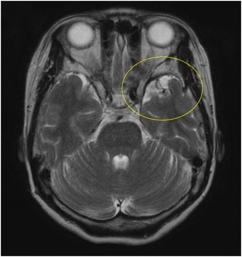 脳出血と高次脳機能障害　頭部MRI