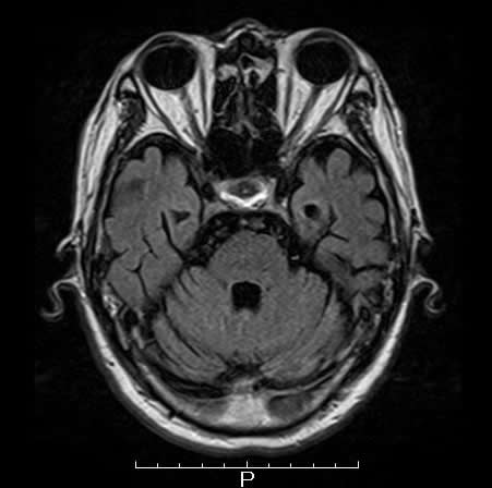 高次脳機能障害・MRI画像（交通事故）